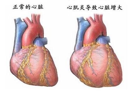 什么是心脏扩大