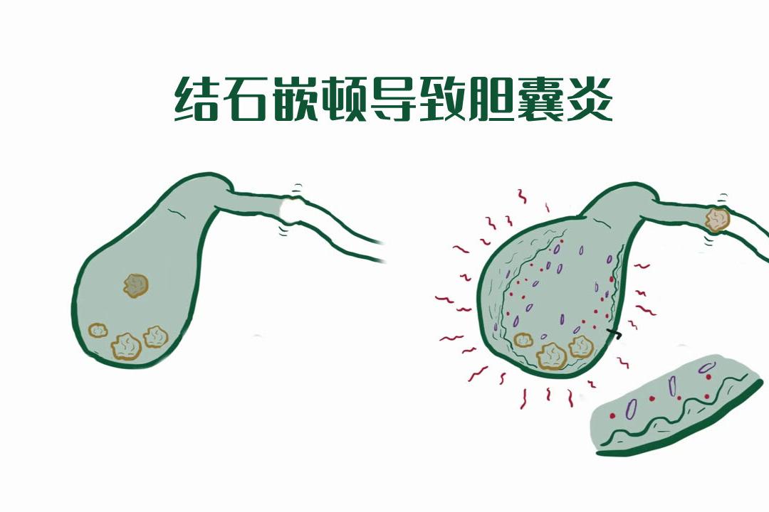 急性胆囊炎