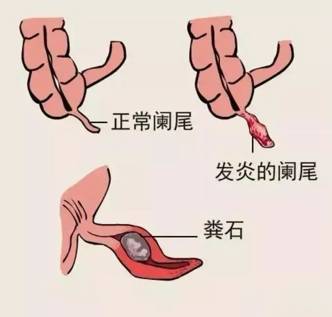 阑尾被认为是最不靠谱的器官，因为它经常发炎、破裂，却无明显生理功能。