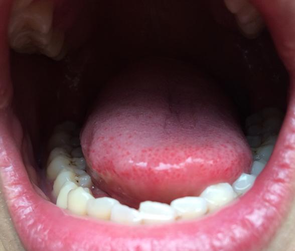 HPV（人乳头瘤病毒）竟然还能引起男性口腔癌！！！！！！！！！要知道HPV是宫颈