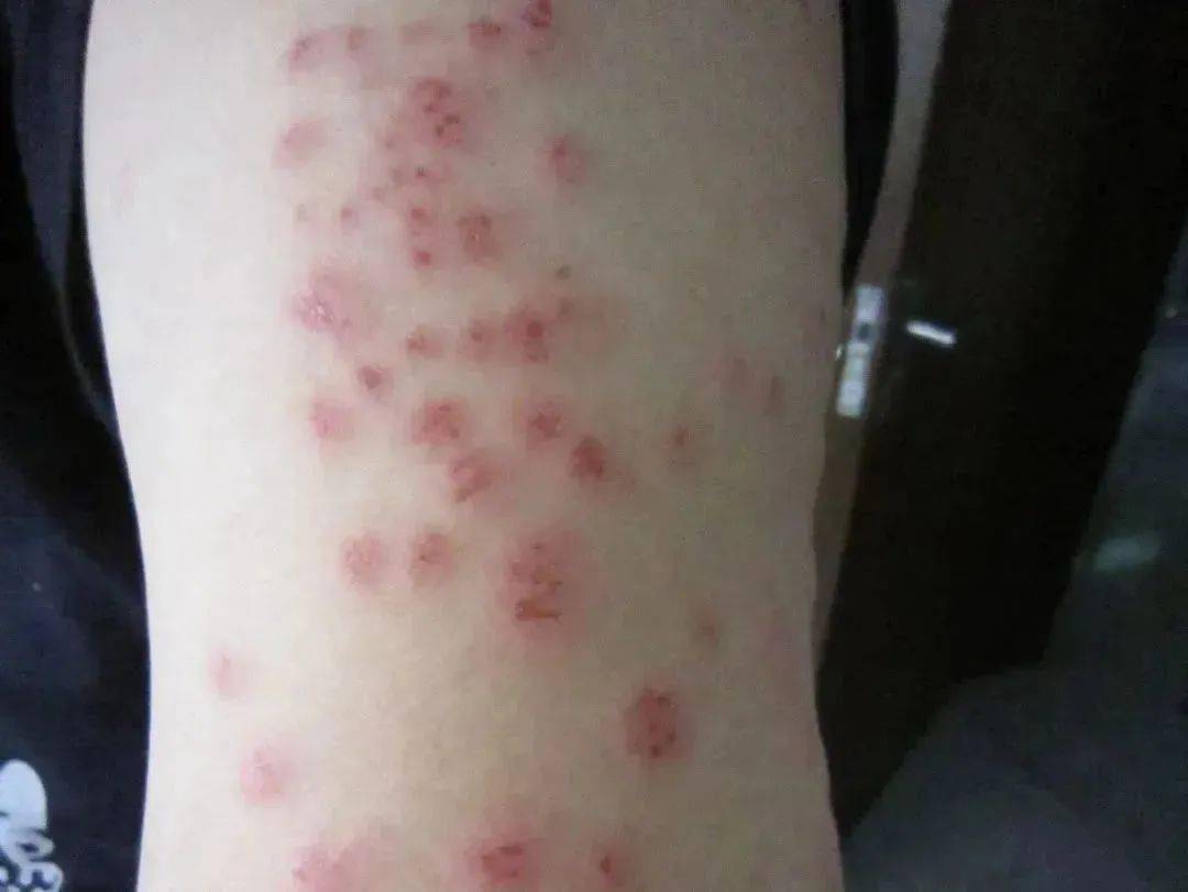 床虱问题已在全球蔓延！为何会出现这种情况？主要原因是床虱繁殖速度快，适应能力强，