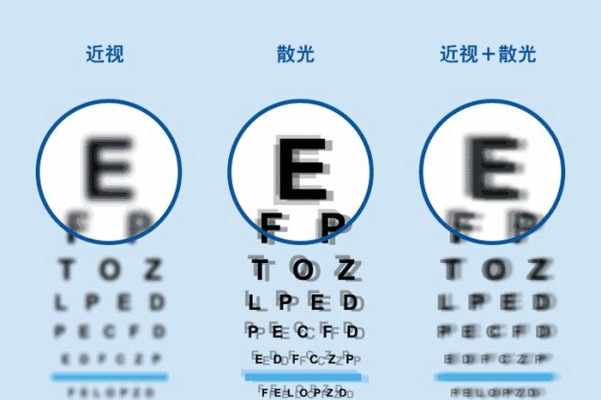 一张图了解近视和散光的区别 
