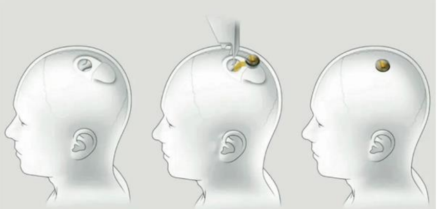 机器植入人脑，马斯克做“人体实验”Neuralink公司首次招募人脑试验，计划通