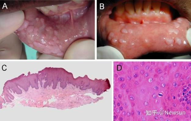 听到了吗？男性HPV感染会导致尖锐湿疣、皮肤粘膜病变，持续高危型HPV感染甚至会