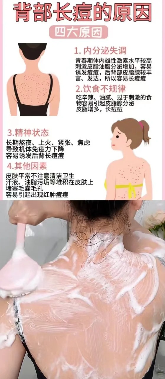 认真洗澡有效去除后背痘 
1.打开毛孔用花洒调好适宜的温度，然后对准身上有痘的地
