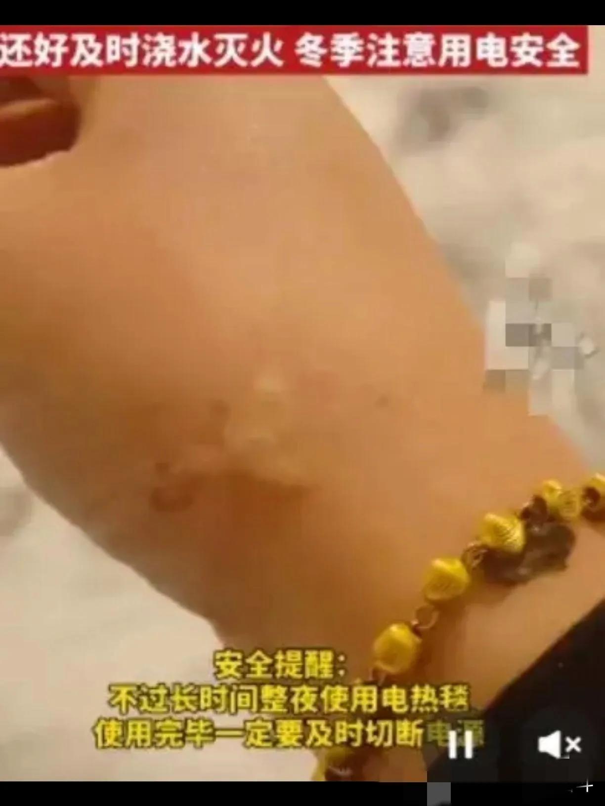 近日，江苏徐州一位女士在开着电热毯睡觉时，突然听到一声异响，惊觉被子竟然被烧着了