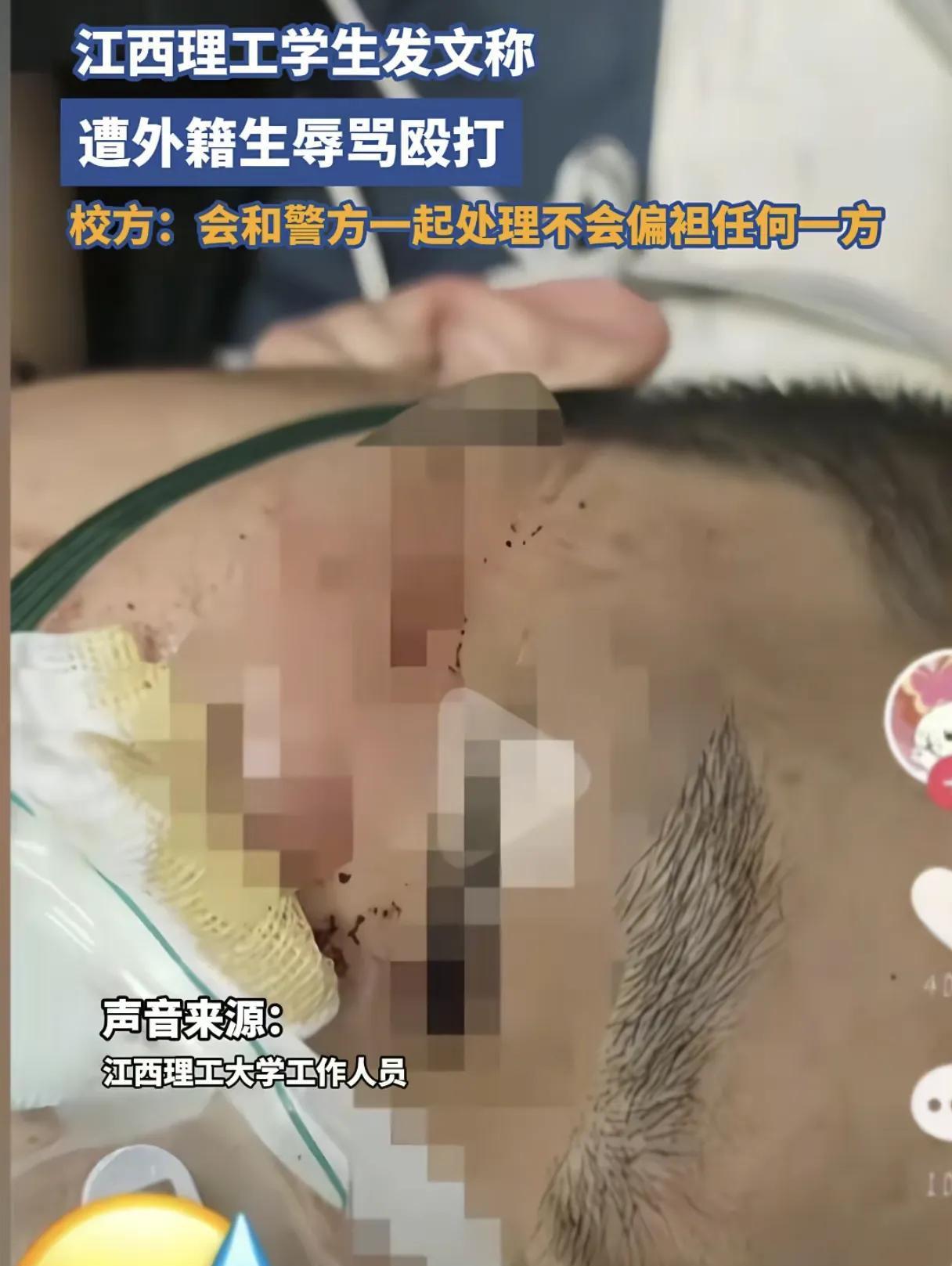 江西理工大学最近出了件让人憋屈的事！中国学生小李在健身房好好锻炼，突然被外籍留学生拔了器材插头，对方不仅宣称“这是我的地盘”，还当场吆喝七八个同伙围殴他。

小李跟对方理论说中文，人家却故意用英文呛声