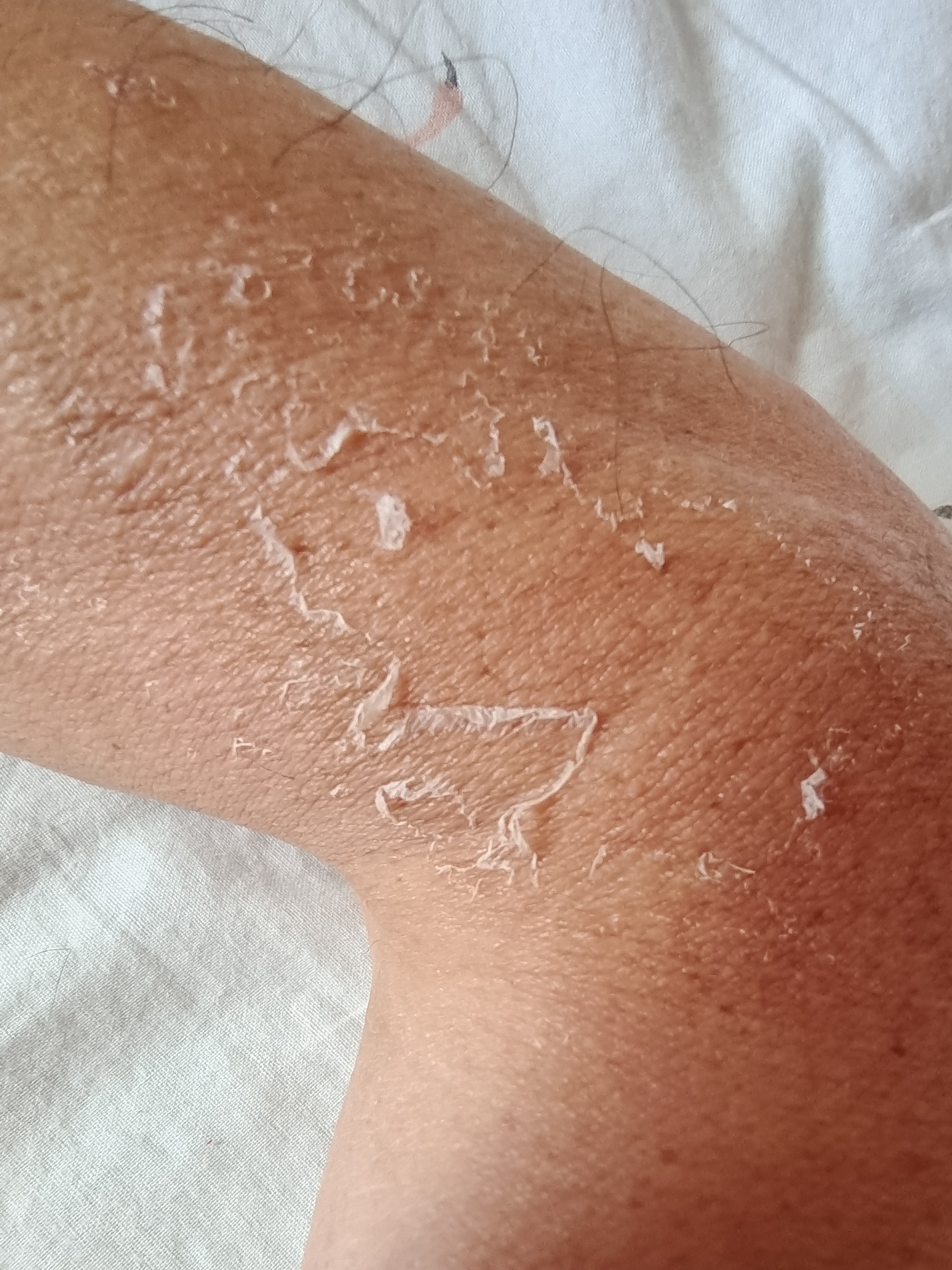 谁要说这不是一只老乡的胳膊呢，现在谁还把自己的胳膊晒爆了皮，看着胳膊黑乎乎的，那是经过风雨见过世面的，每天开摩托车翻山越岭，难免的就被阳光和紫外线，晒成了这个模样，这是今年第四次脱皮了，还没有到伏天，