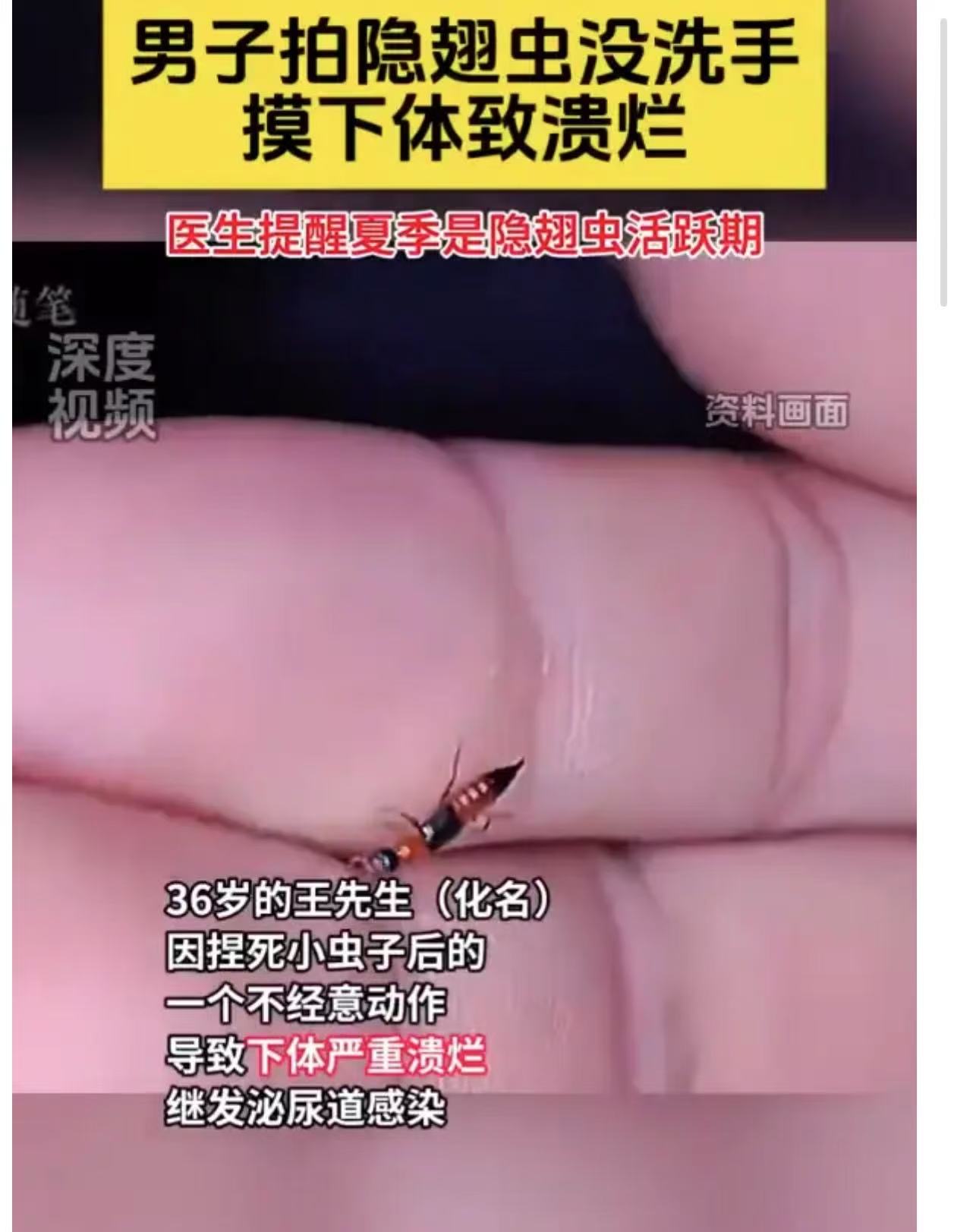 太可怕了！浙江宁波，男子拍死隐翅虫后没洗手，又摸下体后导致溃烂！男子：这种虫子大家一定要小心了，虽然很小但“杀伤力”惊人！

王先生今年36岁，这天晚上，他正惬意地休息着。突然，感觉胳膊上有虫子在爬动