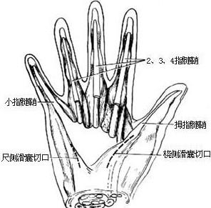 手指腱鞘炎原理图图片